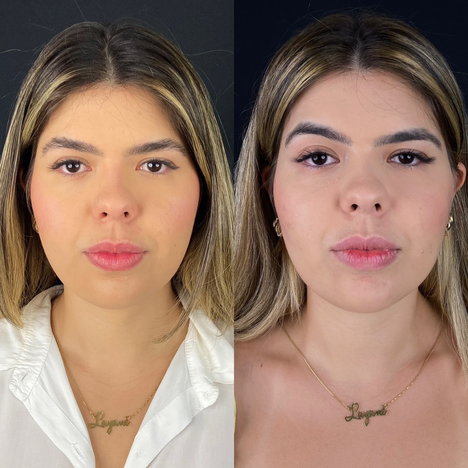 Antes e depois de bichectomia