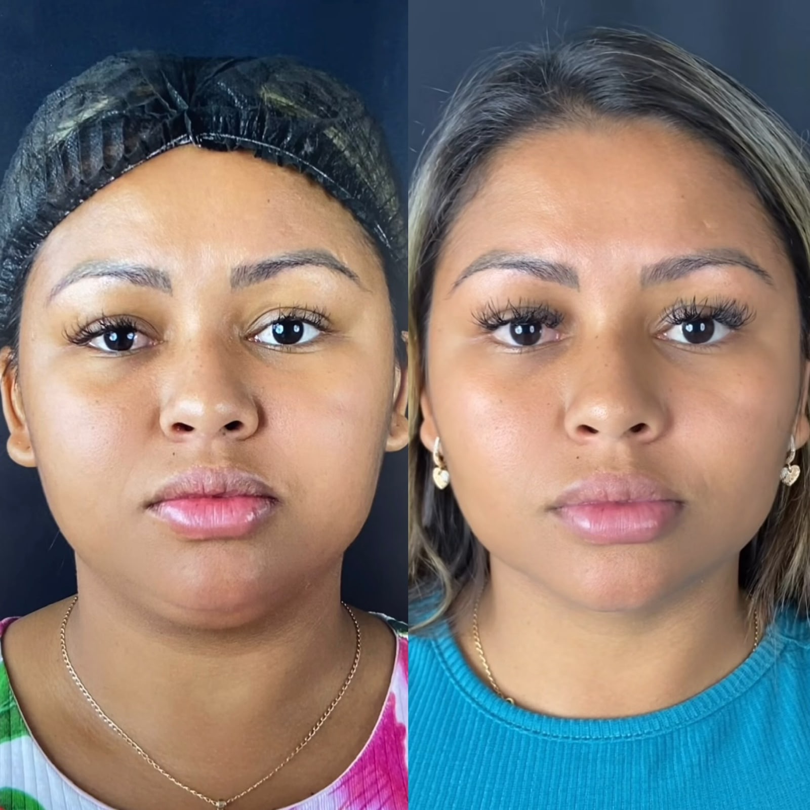 Antes e depois de bichectomia