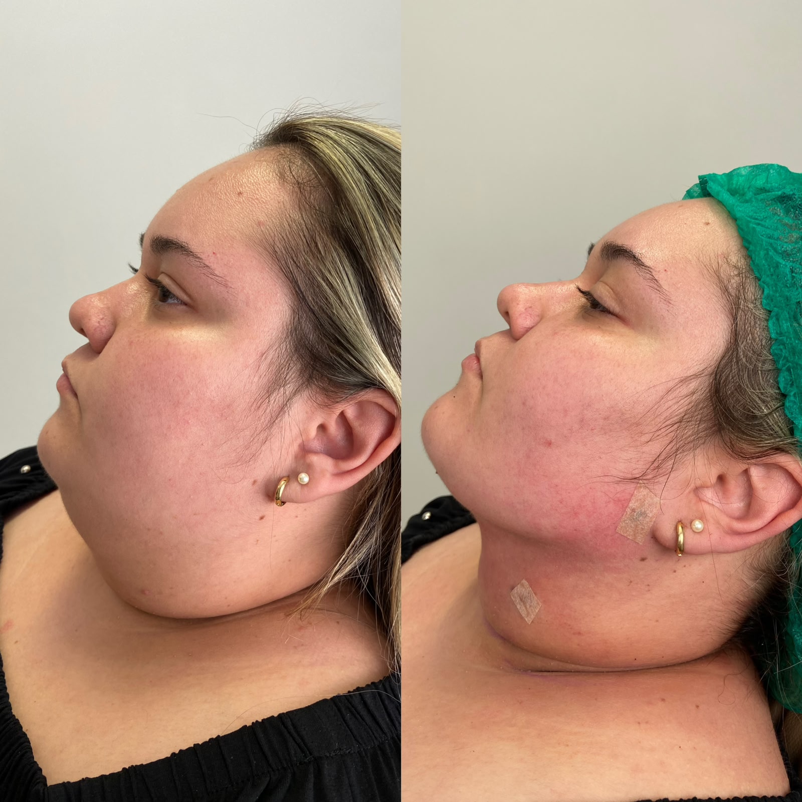 Lipoaspiração Facial
