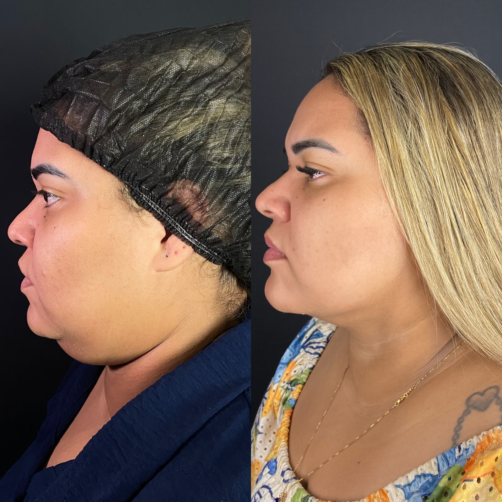 Antes e depois de lipoescultura facial