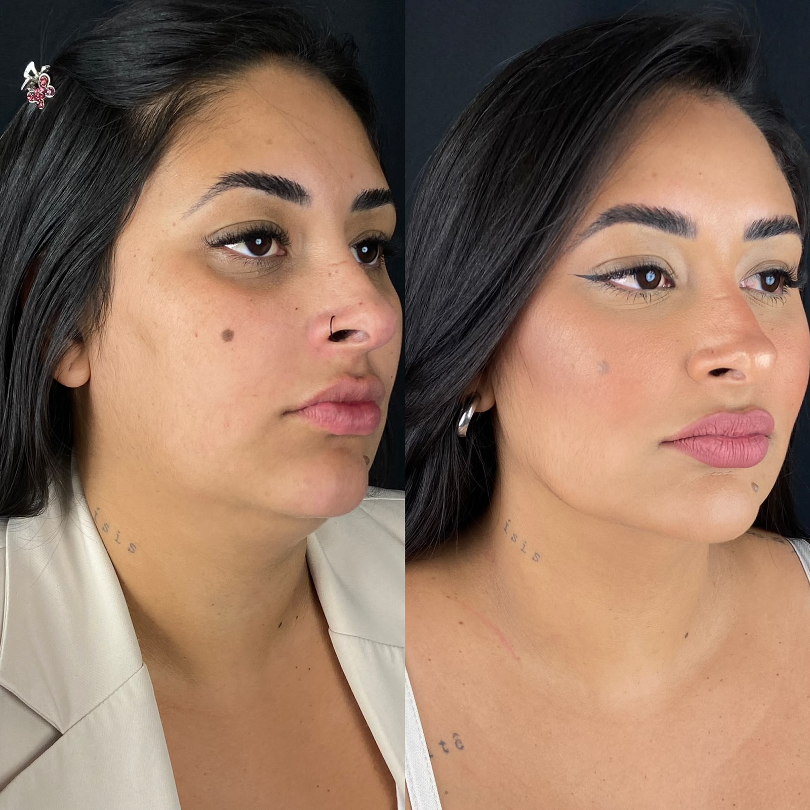 Antes e depois de platismoplastia
