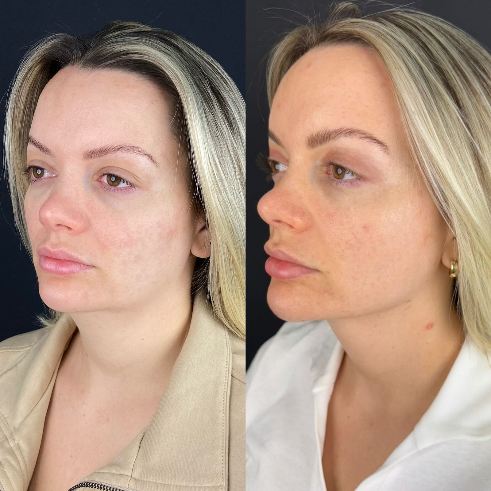 Antes e depois de platismoplastia