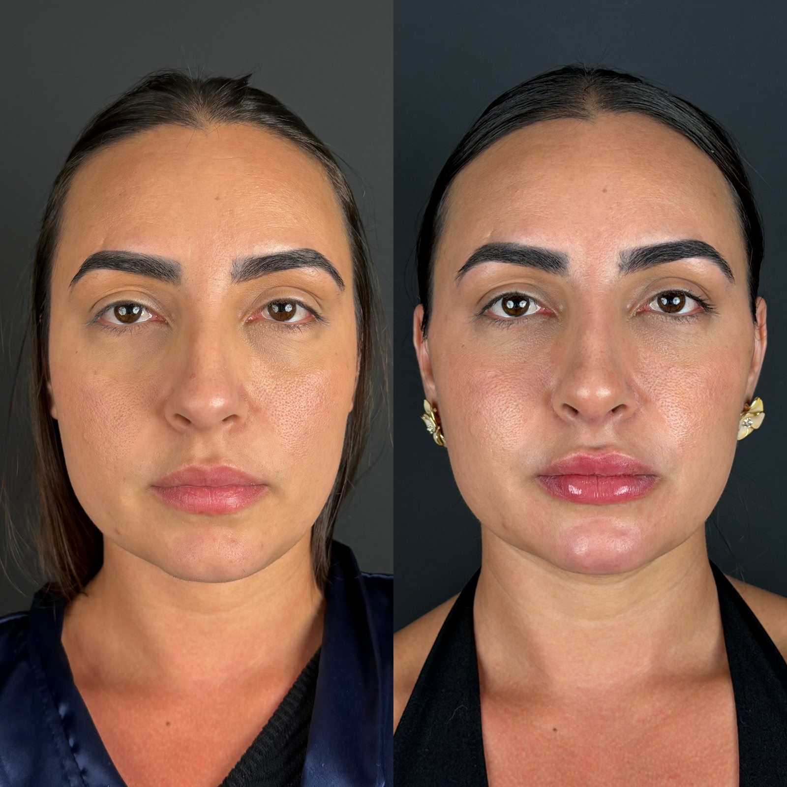 Antes e depois de preenchimento facial
