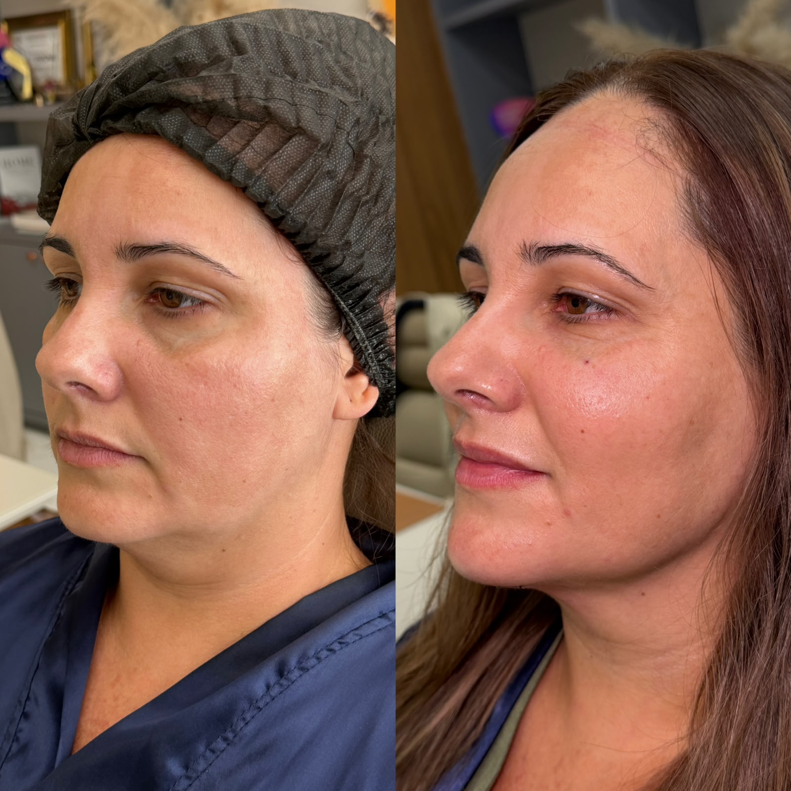 Antes e depois de preenchimento facial