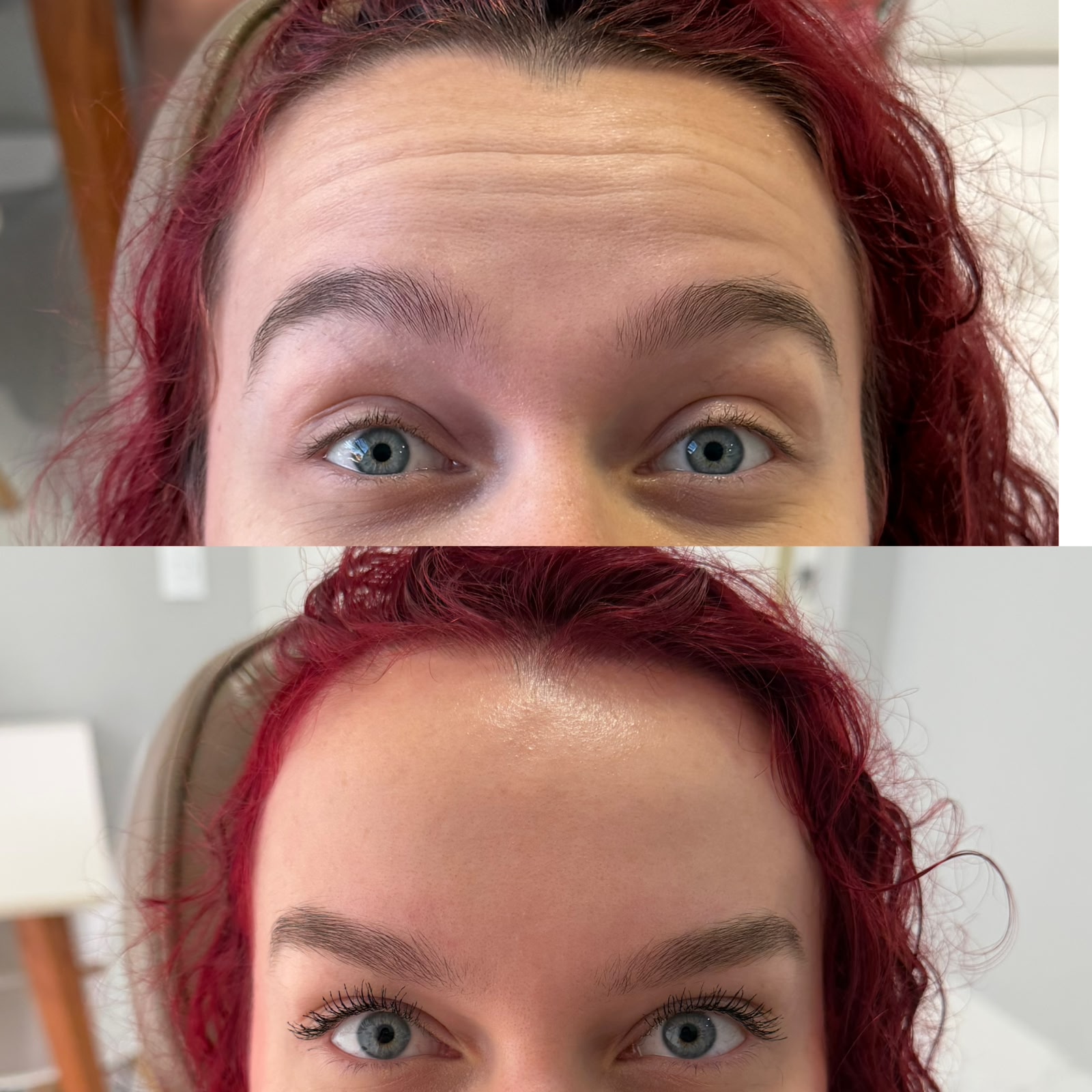Antes e depois de toxina botulínica